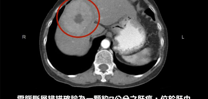 肝腫瘤傳統手術傷口大 港醫微創腹腔鏡助復原快